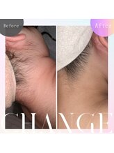 アイリー(IRIE)/うなじ脱毛before/after