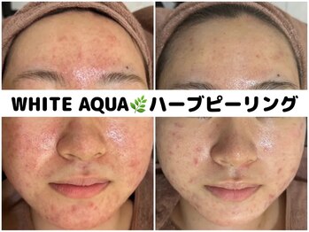 ホワイトアクア 柏店(WHITE AQUA)/ハーブピーリング/肌荒れ改善