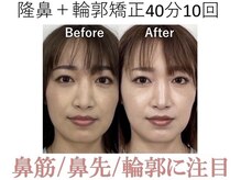 ラプリ 梅田店(Raplit)/隆鼻＋輪郭矯正40分10回