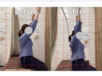 はぴねす鍼灸整骨院 飯田橋サクラテラス院/【飯田橋】施術変化1回