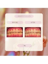 プラスビー 2号店(+b)/ホワイトニングビフォーアフター