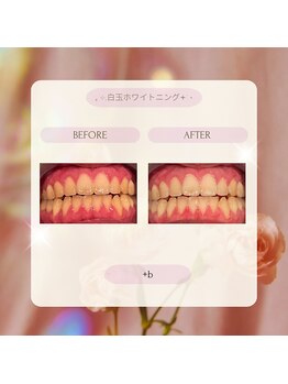 プラスビー 2号店(+b)/ホワイトニングビフォーアフター