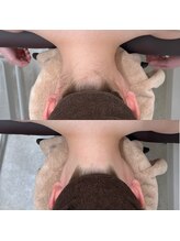 ミース 静岡駅前店/脱毛1回目から驚くほどスッキリ