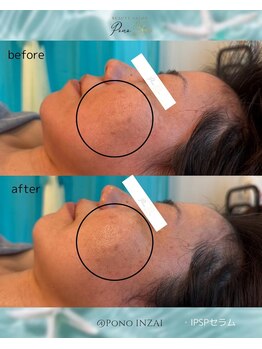 ポノ(Pono)/一度の施術効果☆