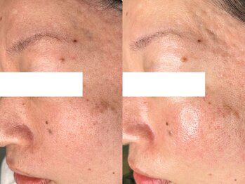 ラトナ(RATNA)/シルクスキン