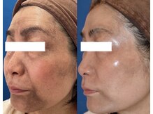 サローネファミリア(SALONE FAMILIA)/濃くなった色素がご覧の通り