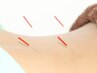 指じゃ届かない！【スタンダート鍼（トリガーポイント鍼）】★初回限定¥3980