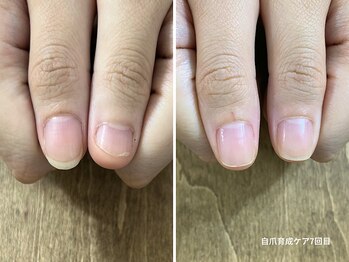 コバコ(kobaco)/弄り癖改善　8ヶ月の成果比較