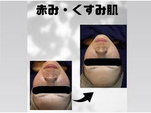 ワン(One)の雰囲気（赤み・くすみでお悩みの方のハーブピーリング1回後のお肌です。）