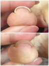 巻き爪フットケア1本