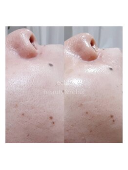 エクラ(eclat)/ACトリートメント