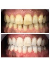 セルフダック いわき小名浜店(SELFDUCK)/◇ホワイトニングの症例写真3