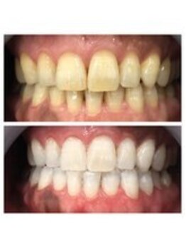 セルフダック いわき小名浜店(SELFDUCK)/◇ホワイトニングの症例写真3