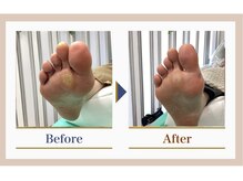 巻き爪補正店 錦糸町店/【タコ・魚の目ケア】