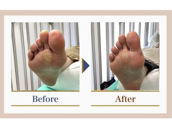 巻き爪補正店 錦糸町店/【タコ・魚の目ケア】