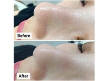 ハクア(HAQUA)/ハイドラ毛穴洗浄