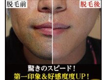 feelにお任せ下さる『メンズひげ脱毛』の方、過去最多♪