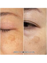 ミコ(mico)/シミケア