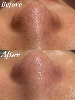 コリー(Kolly)/毛穴洗浄