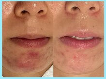 ハーブピーリング 名古屋/LALAピール