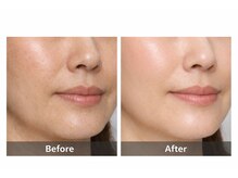 フォーグッド(forgood)/40代女性｜顔脱毛5回の変化