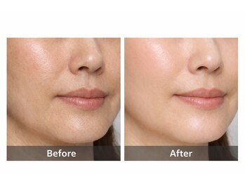 フォーグッド(forgood)/40代女性｜顔脱毛5回の変化