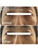 デディア 恵比寿(dedia)/濃ゆい目の下のくま撃退するなら