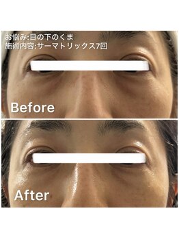 デディア 恵比寿(dedia)/濃ゆい目の下のくま撃退するなら