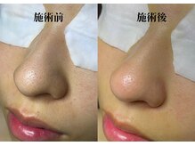 他店やレーザーなどて改善されなかった毛穴悩みもお任せ下さい！