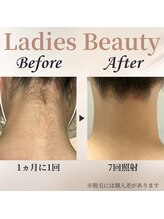 シャーロック(4869Sherlock)/うなじBeforeAfter