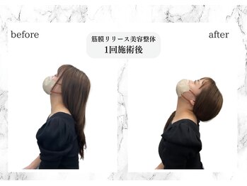トキ(TOKI)/筋膜リリース美容整体 施術直後