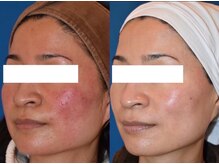 サローネファミリア(SALONE FAMILIA)/敏感肌もご覧の通り