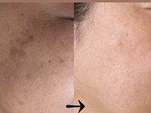 サロン ドロップ 上小田井(Salon drop)/「シミ改善」途中経過