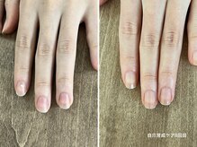 コバコ(kobaco)/自爪育成ケア　8ヶ月の成果