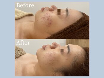 アイミーモア 国立店(aimer more)/陶肌トリートメントBef＆Aft