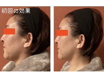 ロイヤリティ(ROYALTY)/二重アゴ、ほうれい線