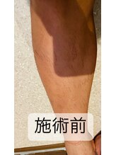 ゴッド(GOD)/足脱毛