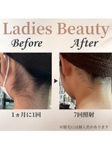 シャーロック(4869Sherlock)/うなじBeforeAfter