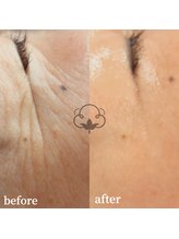 プライベートサロン コットン(COTTON)/オーダーメイド幹細胞プラズマ