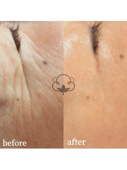 プライベートサロン コットン(COTTON)/オーダーメイド幹細胞プラズマ