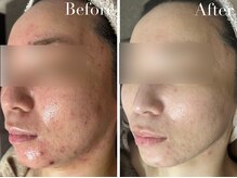 アブニールブリヨン/2BBioハーブピーリング/肌質改善