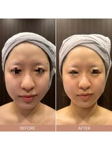 ビーエヌ エステティックアンドスパ(BN Esthetic&Spa)/小顔コルギ