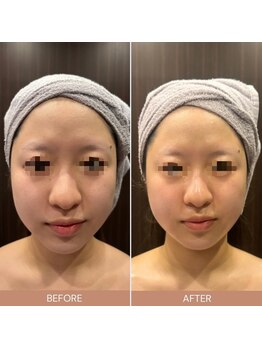 ビーエヌ エステティックアンドスパ(BN Esthetic&Spa)/小顔コルギ