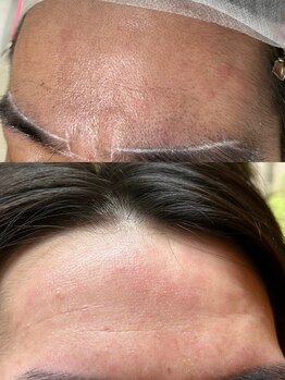 ルモア(Lumor)/フェイスワックス｜額