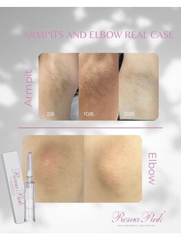 アドラーブル プレ葉ウォーク浜北店/ローマピンク　ワキ・ヒザ症例