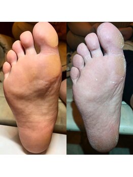 リラフ(Re:laugh)の写真/足裏の角質除去と保湿で素足に自信を！乾燥や紫外線が気になる季節も潤うケアを体験して♪