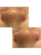 メゾリーナ(MAISOReNA)/いちご鼻とサヨナラ