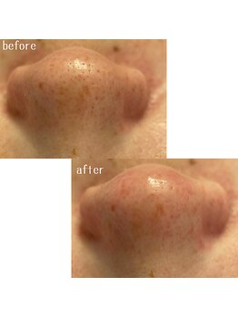 メゾリーナ(MAISOReNA)/いちご鼻とサヨナラ