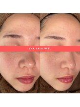 サンク(cinq)/韓国で人気No．１ララピール☆彡