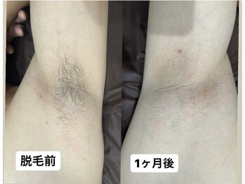 アカラ 読谷店(AKALA)/ワキ脱毛